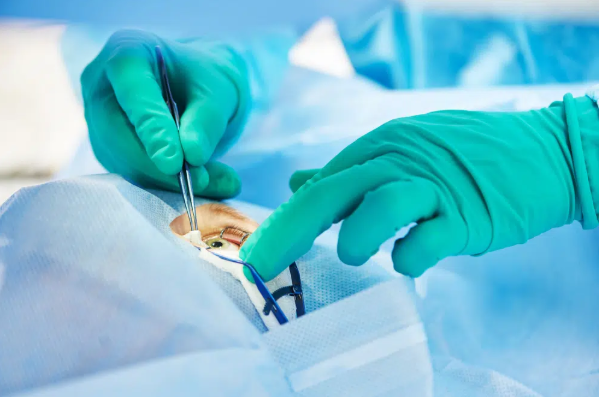 How Epi-LASIK Works and Who May Be Suitable for It